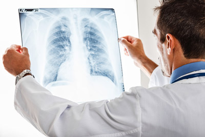 lung cancer