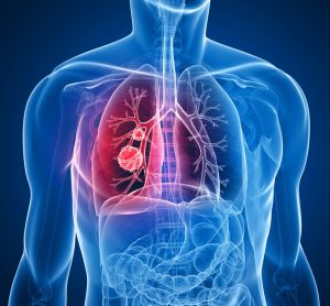 Illustration of a mass within the lungs in a human torso - idea of lung cancer