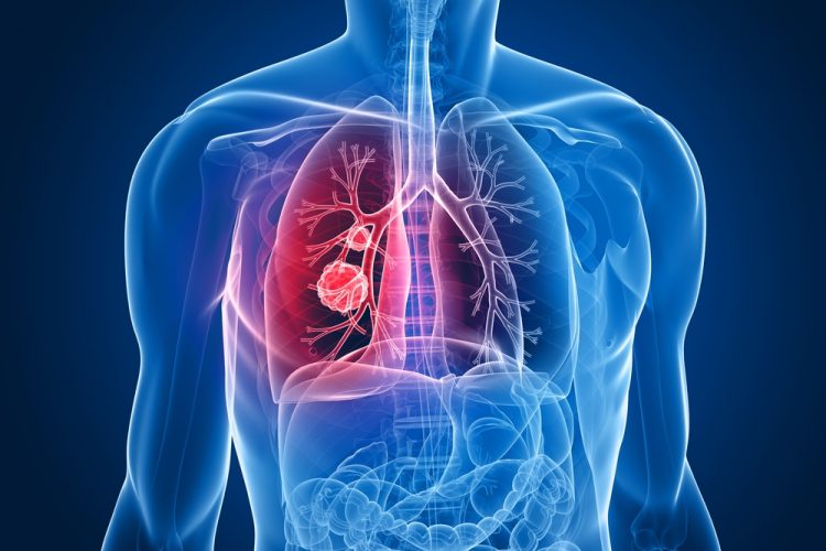 Illustration of a mass within the lungs in a human torso - idea of lung cancer