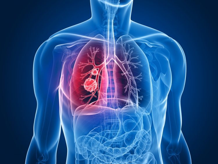 Illustration of a mass within the lungs in a human torso - idea of lung cancer