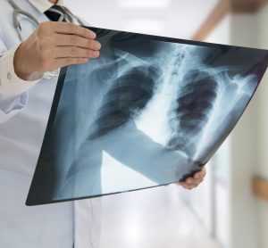 doctor examining a chest x-ray