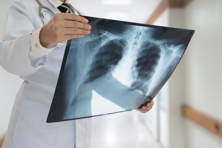 doctor examining a chest x-ray