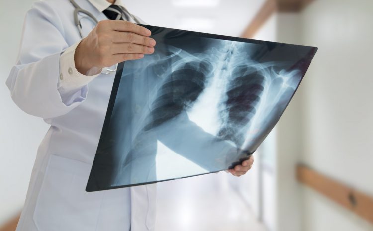 doctor examining a chest x-ray