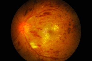 macular-oedema