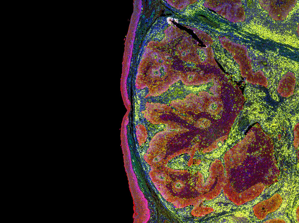 what is peritoneal carcinomatosis