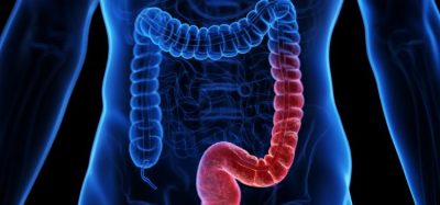 Eli Lily ulcerative colitis antibody drug mirikizumab doubles remission rates