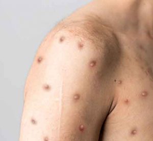 Bavarian Nordic A/S has signed a supply contract with an undisclosed country for the company’s smallpox vaccine, in response to the monkeypox outbreak.