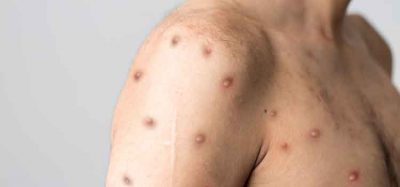 Bavarian Nordic A/S has signed a supply contract with an undisclosed country for the company’s smallpox vaccine, in response to the monkeypox outbreak.