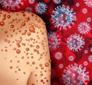 Three dimensional illustration of back of infected person's right shoulder surrounded by monkeypox viruses on red background