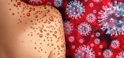 Three dimensional illustration of back of infected person's right shoulder surrounded by monkeypox viruses on red background