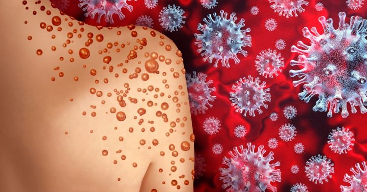 Three dimensional illustration of back of infected person's right shoulder surrounded by monkeypox viruses on red background