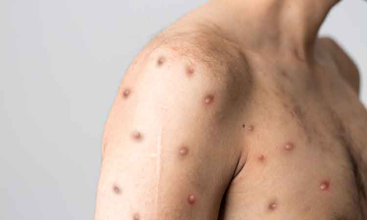 Bavarian Nordic A/S has signed a supply contract with an undisclosed country for the company’s smallpox vaccine, in response to the monkeypox outbreak.