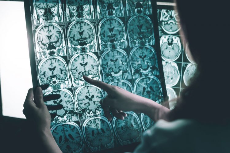 Alzheimer's MRI scan