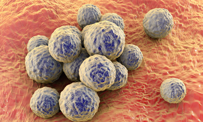 Treatment for MRSA no longer more costly than for susceptible Staph aureus infections