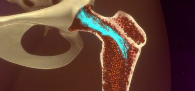 NICE recommends ixazomib all-oral treatment for multiple myeloma