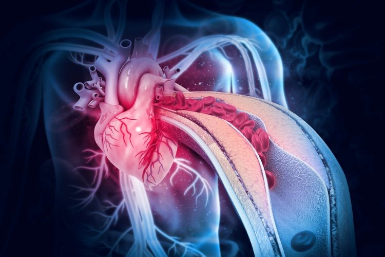 First clinical trial will test new heart attack drug