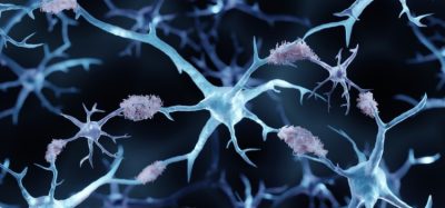 concept of neurodegenerative disease - neurons surrounded by amyloid plaques
