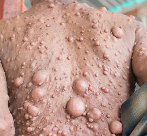 person with large neurofibromas on their back