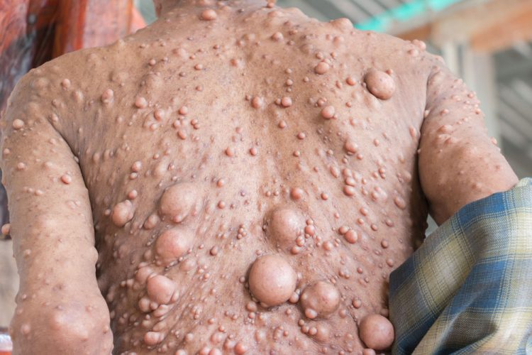 person with large neurofibromas on their back