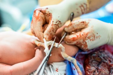 doctor wearing gloves about to cut a newborn baby's umbilical cord