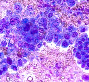 Phogomicrograph of fine needle aspiration (FNA) cytology of a pulmonary (lung) nodule showing adenocarcinoma, a type of non-small cell lung cancer
