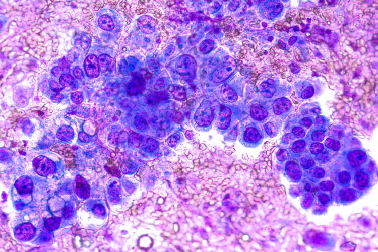 Phogomicrograph of fine needle aspiration (FNA) cytology of a pulmonary (lung) nodule showing adenocarcinoma, a type of non-small cell lung cancer