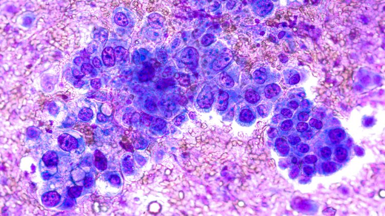 Phogomicrograph of fine needle aspiration (FNA) cytology of a pulmonary (lung) nodule showing adenocarcinoma, a type of non-small cell lung cancer