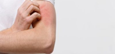 Could oral difelikefalin be first FDA-approved drug for notalgia paresthetica?