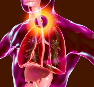 3D illustration showing malignant tumor in the human oesophagus