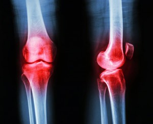 osteoarthritis-hydros-ta