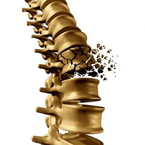 osteoporosis fracture