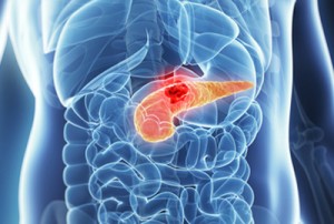 pancreatic cancer