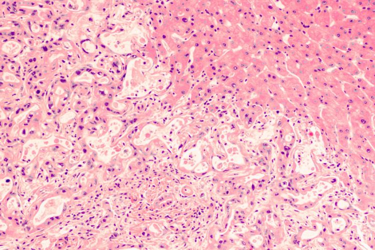 Lutathera pancreatic cancer