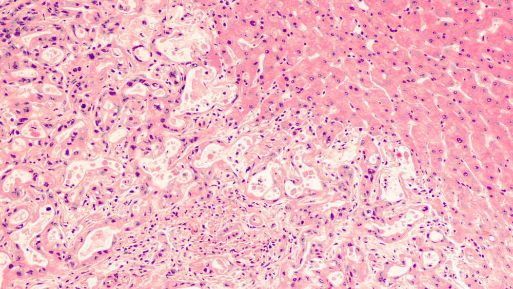 Lutathera pancreatic cancer