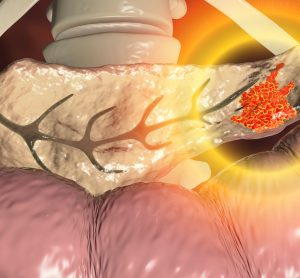 realistic image of a pancreas within the body cavity, with an orange section indication a cancerous pancreatic tumour