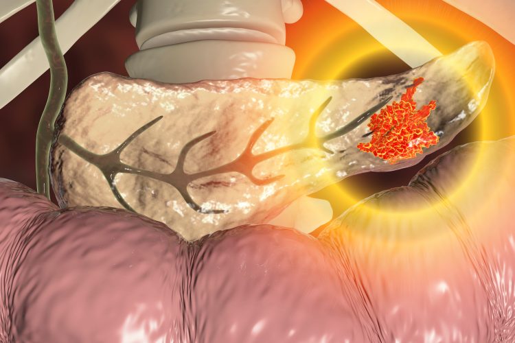 realistic image of a pancreas within the body cavity, with an orange section indication a cancerous pancreatic tumour