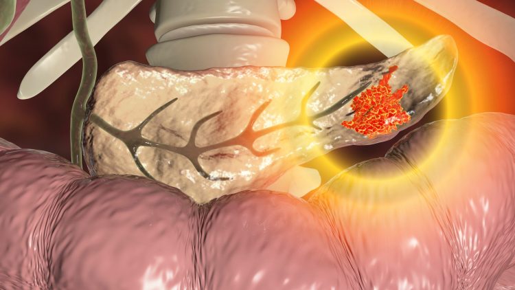 realistic image of a pancreas within the body cavity, with an orange section indication a cancerous pancreatic tumour