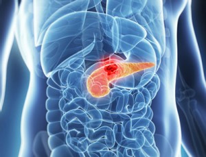 pancreatic-cancer
