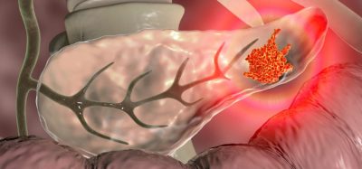 Onivyde improves survival in Phase III Pancreatic Ductal Adenocarcinoma trial