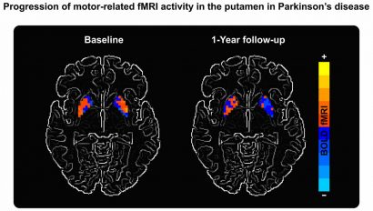 biomarker parkinsons brain imaging