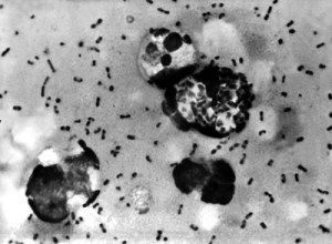 Yersinia pestis plague