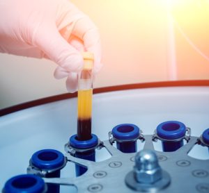 concept of blood plasma-derived therapy production - hand removing a test tube of blood from a centrifuge with large section of yellow blood plasma separated at the top