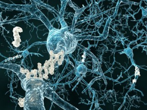 aducanumab alzheimer