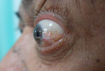 image of a patient with proptosis, or bulging eye