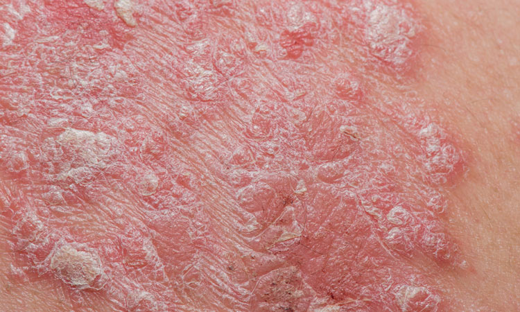 Psoriasis