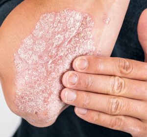 close up of a man's elbow with a large flaky and scaly skin patch caused by psoriasis