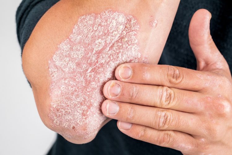 close up of a man's elbow with a large flaky and scaly skin patch caused by psoriasis