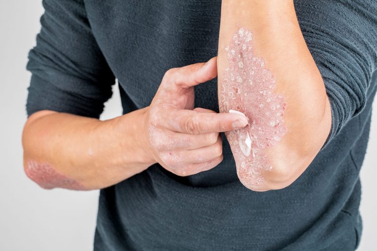 man rubbing cream into a large scaled patch of psoriasis by his elbow