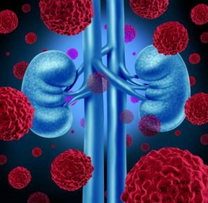 renal cell carcinoma