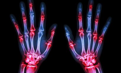 rheumatoid-arthritis